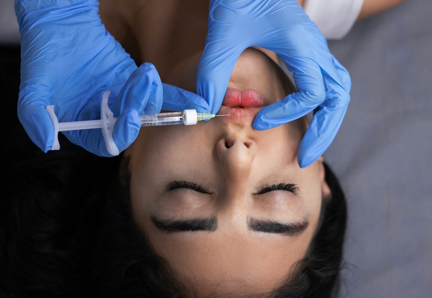 Aplicación de ácido hialurónico en los labios