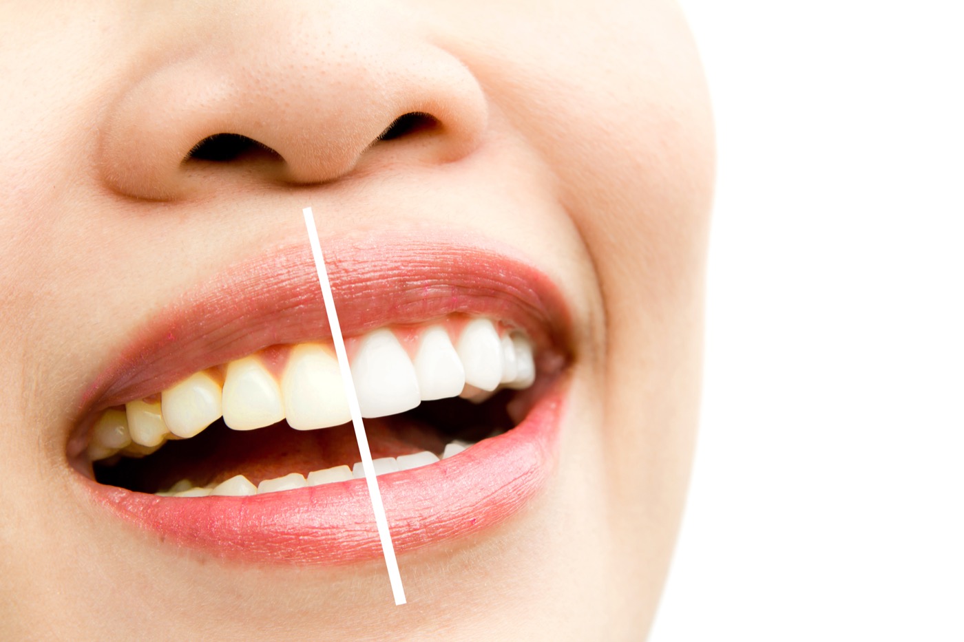 Aplicación de blanqueamiento dental total