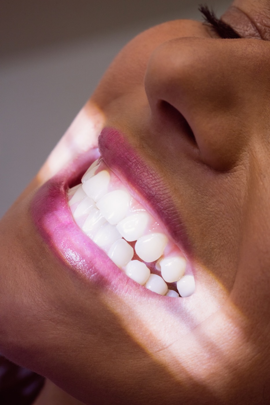 Procedimiento de blanqueamiento dental