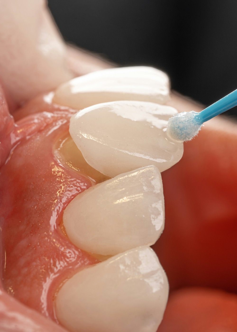 Carilla dental sobre el diente para mejorar su apariencia