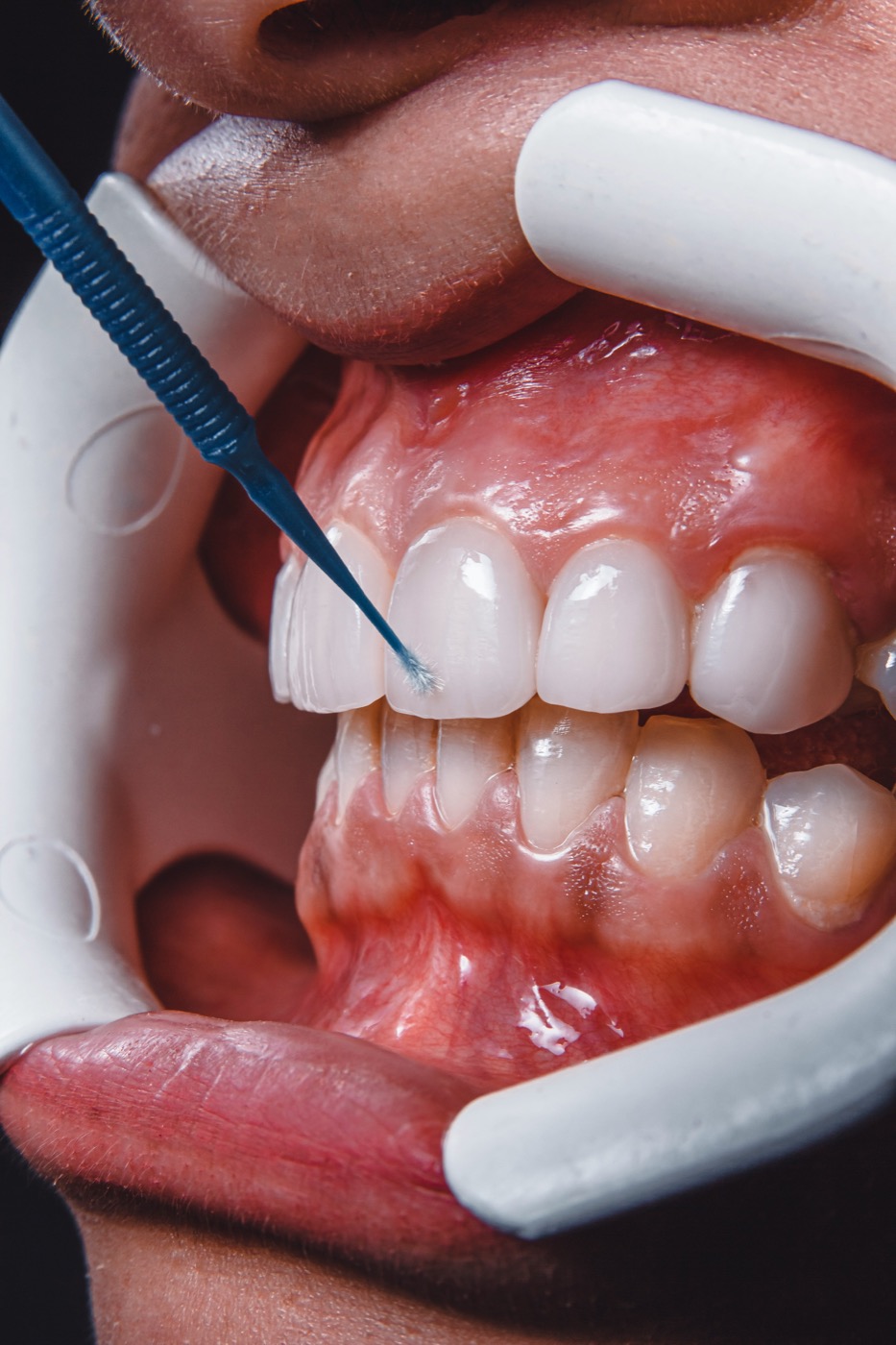 Aplicación de barniz de flúor sobre los dientes