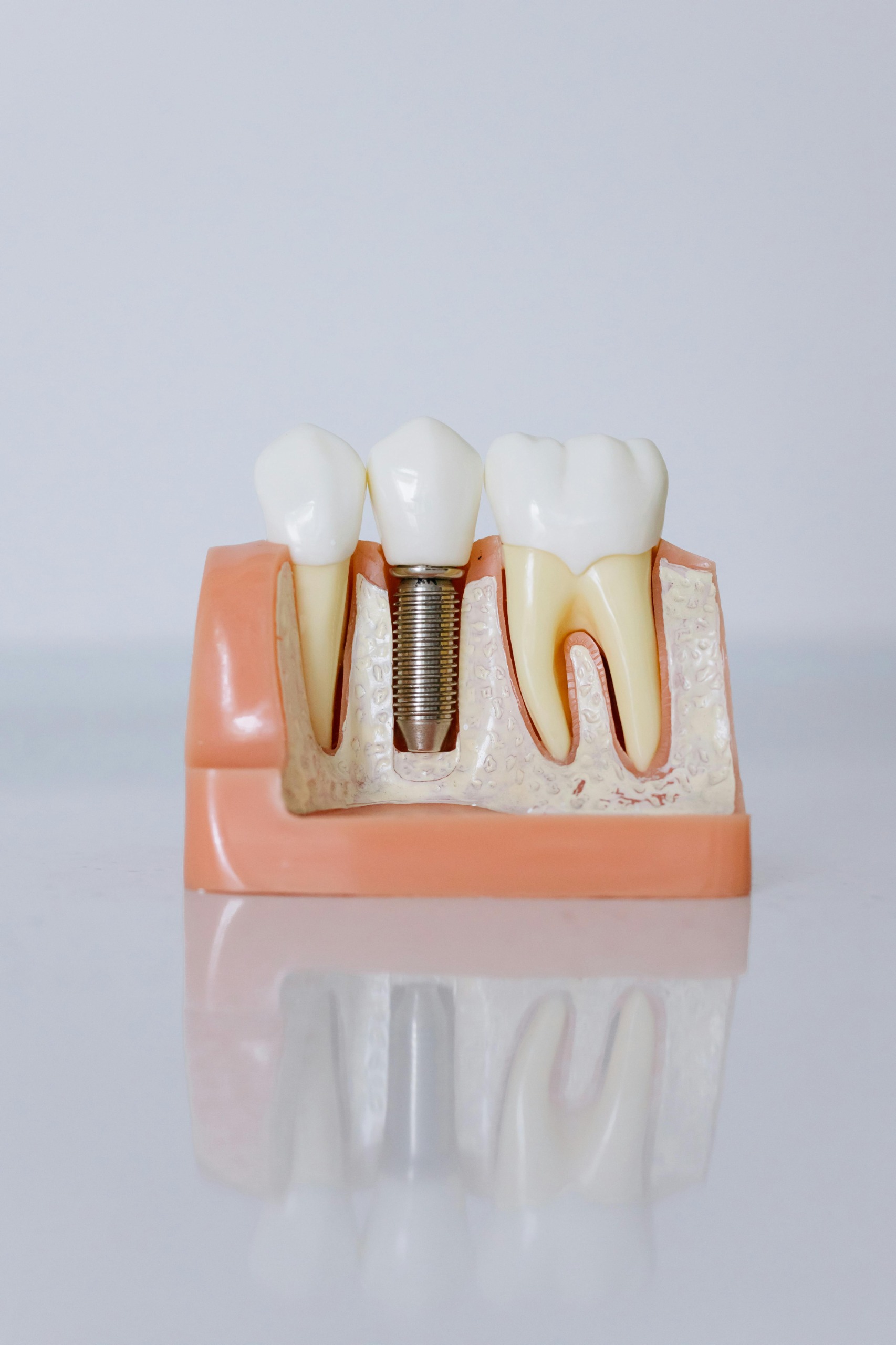 Modelo de implante dental sobre el hueso