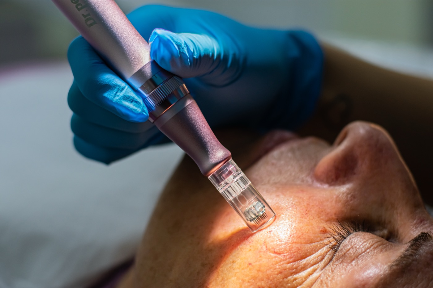 Aplicación de mesoterapia facial con inyección