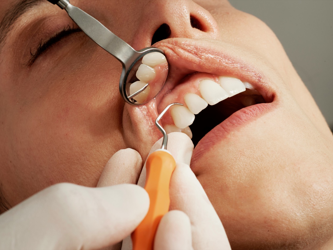 Examen periodontal de encías con espejo y sonda