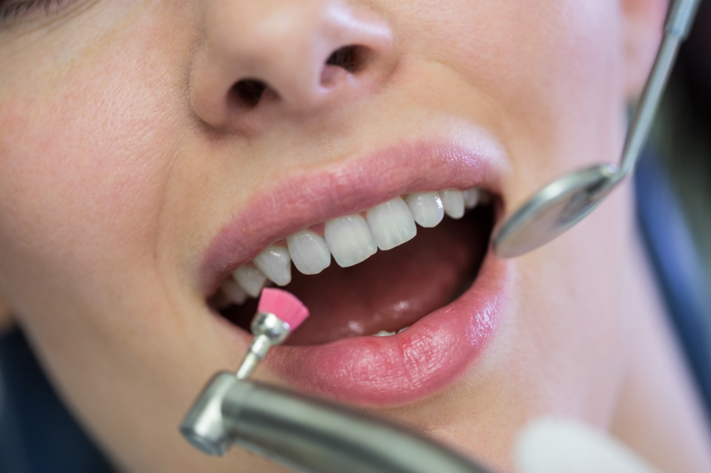 Pulido coronario tras el retiro de brackets